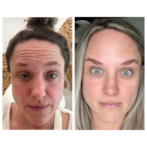 Before:After Before / After Photo Botox