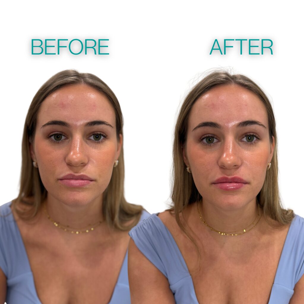 Young blonde woman showing a Lip Filler before and after comparison after a lip filler injection performed in Jacksonville, FL.