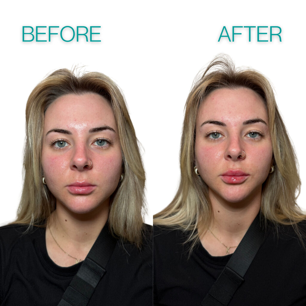 Young woman lip filler before and after comparison after a lip filler injection performed in Jacksonville, FL.