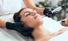 A young woman getting microneedling treatment