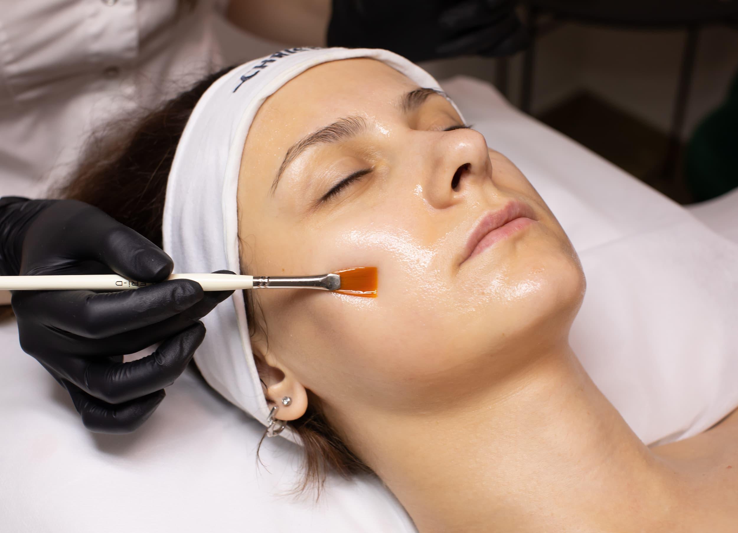 A woman receiving a chemical peel treatment in a medical spa after weeks of preparation.