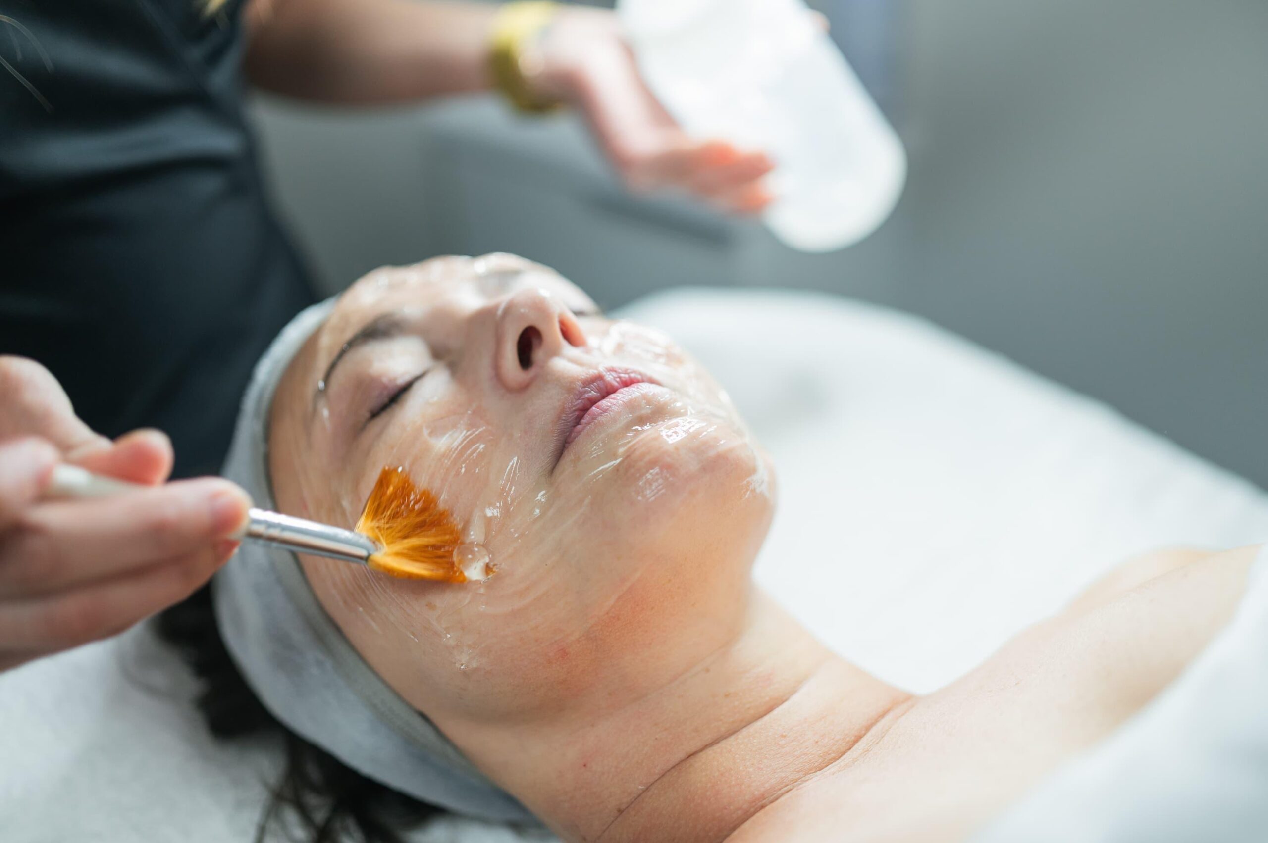Medium depth peel for Hyperpigmentation