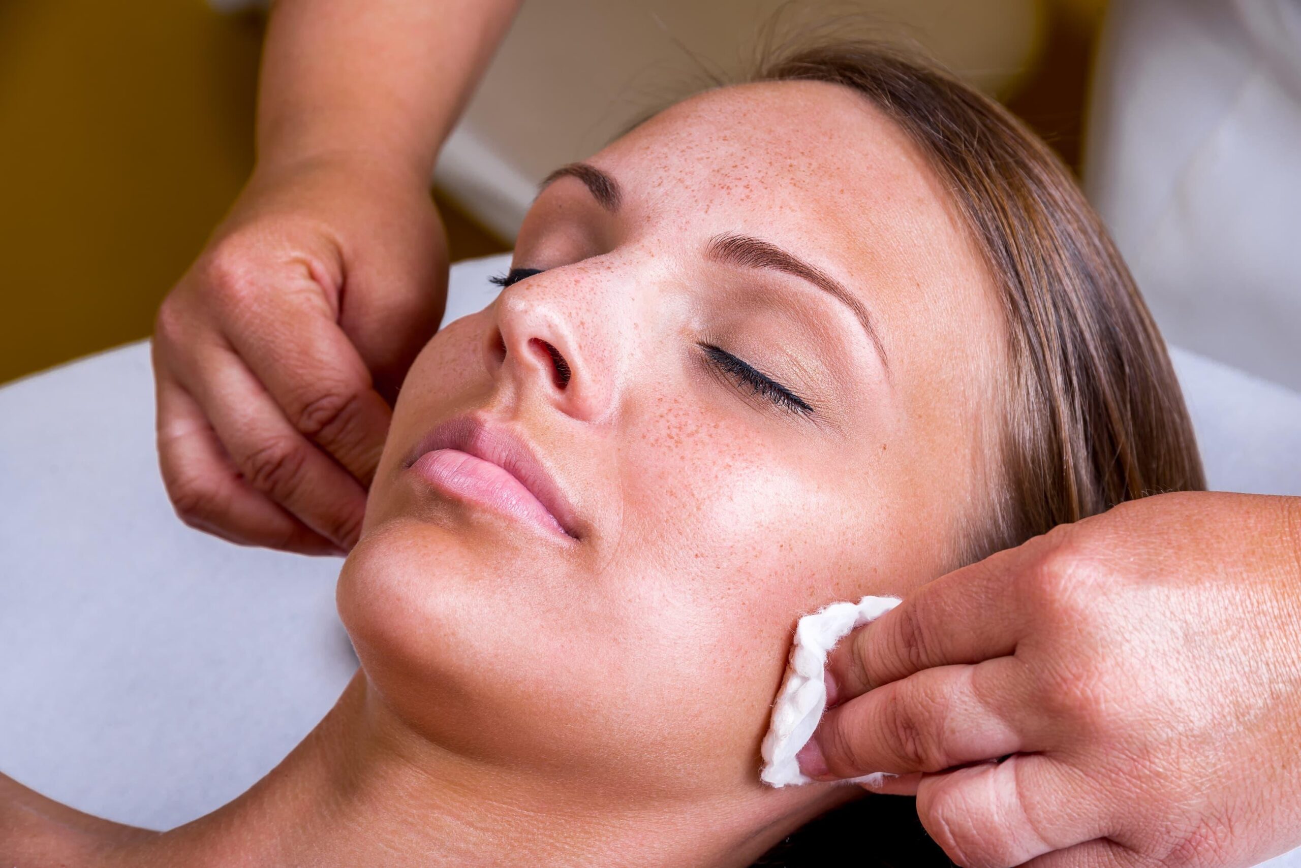 Chemical peel being used to treat hyperpigmentation on a young woman