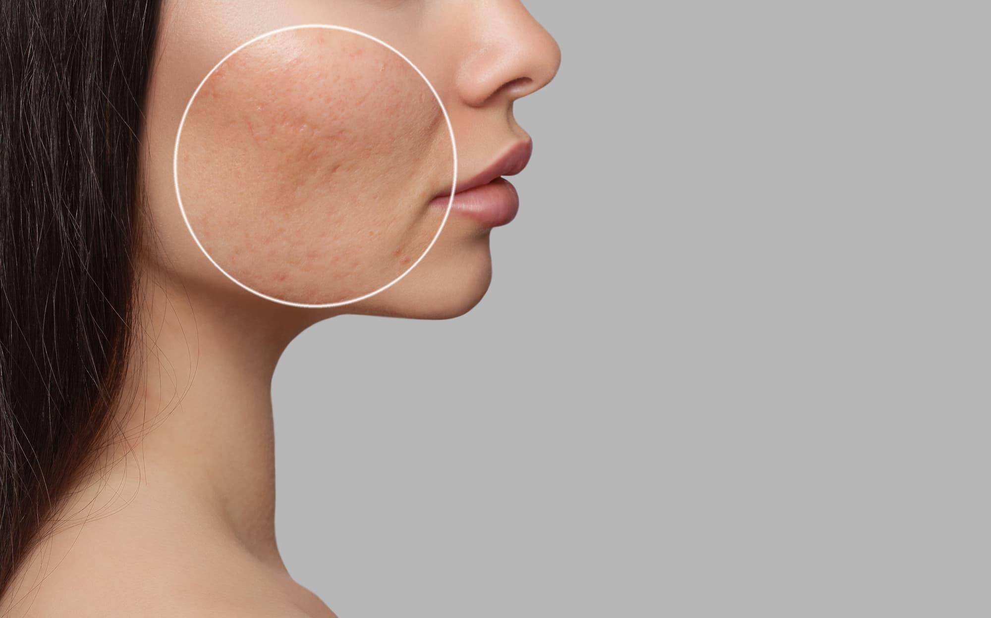 Hyperpigmentation identified on a young woman