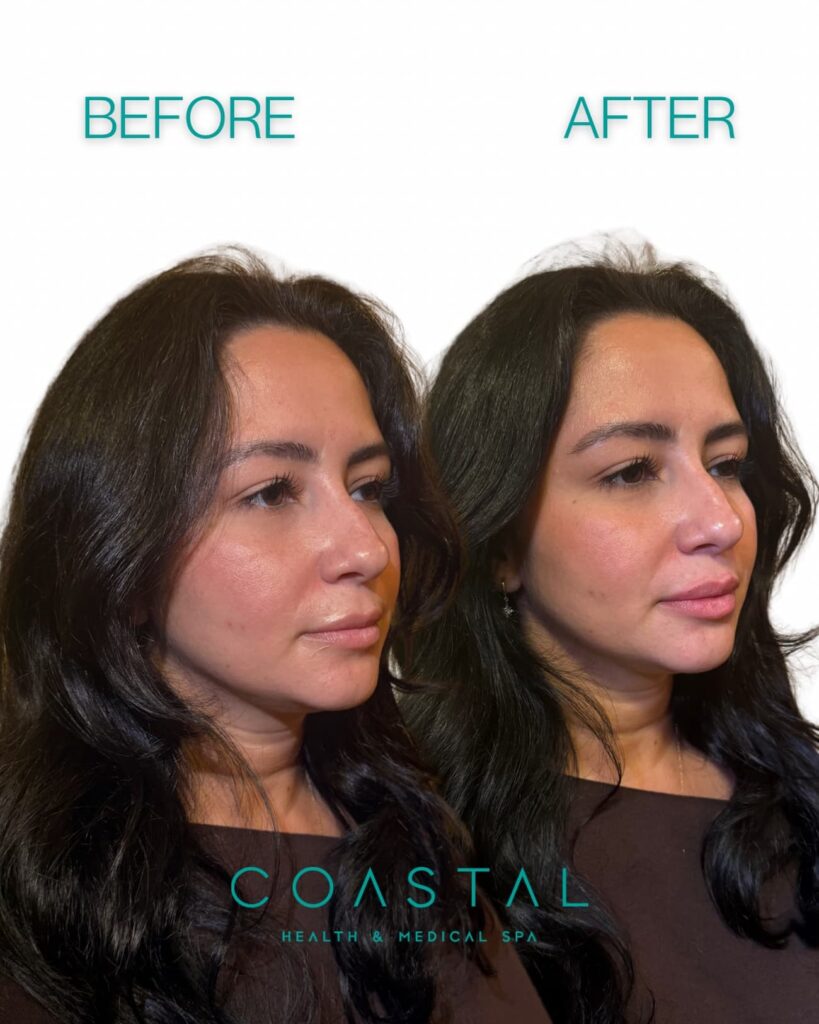 Before and after close up photo of a natural looking lip filler on a woman done by coastal health & medical spa in Jacksonville, FL
