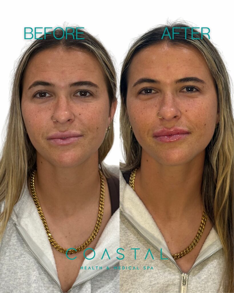 Lip filler before and after comparison photo for a young woman in Jacksonville, FL