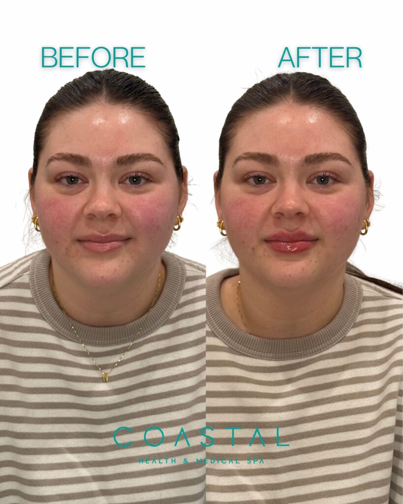 Comparison showing a woman before getting lip filler and after getting lip filler at a Jax med spa.