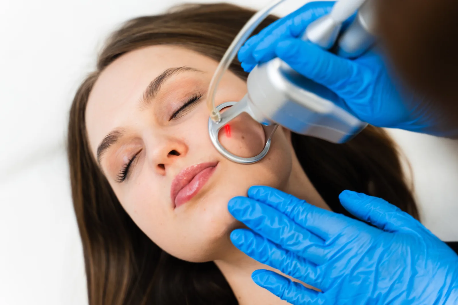 A woman receiving CO2 laser skin resurfacing for active acne treatment at Coastal Health & Medical Spa in Jacksonville, FL
