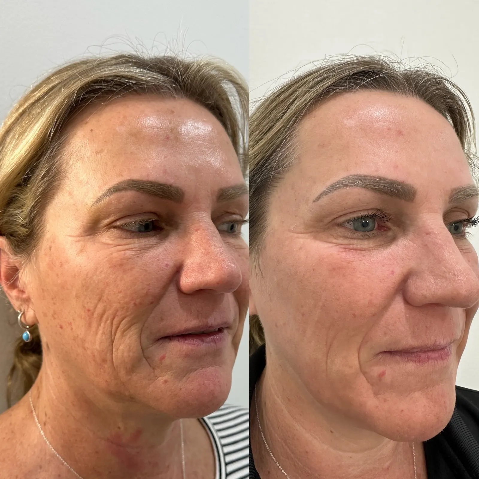 Before and after CO2 laser skin resurfacing showing overall texture, tone, and fine-line improvement using the Alma Hybrid