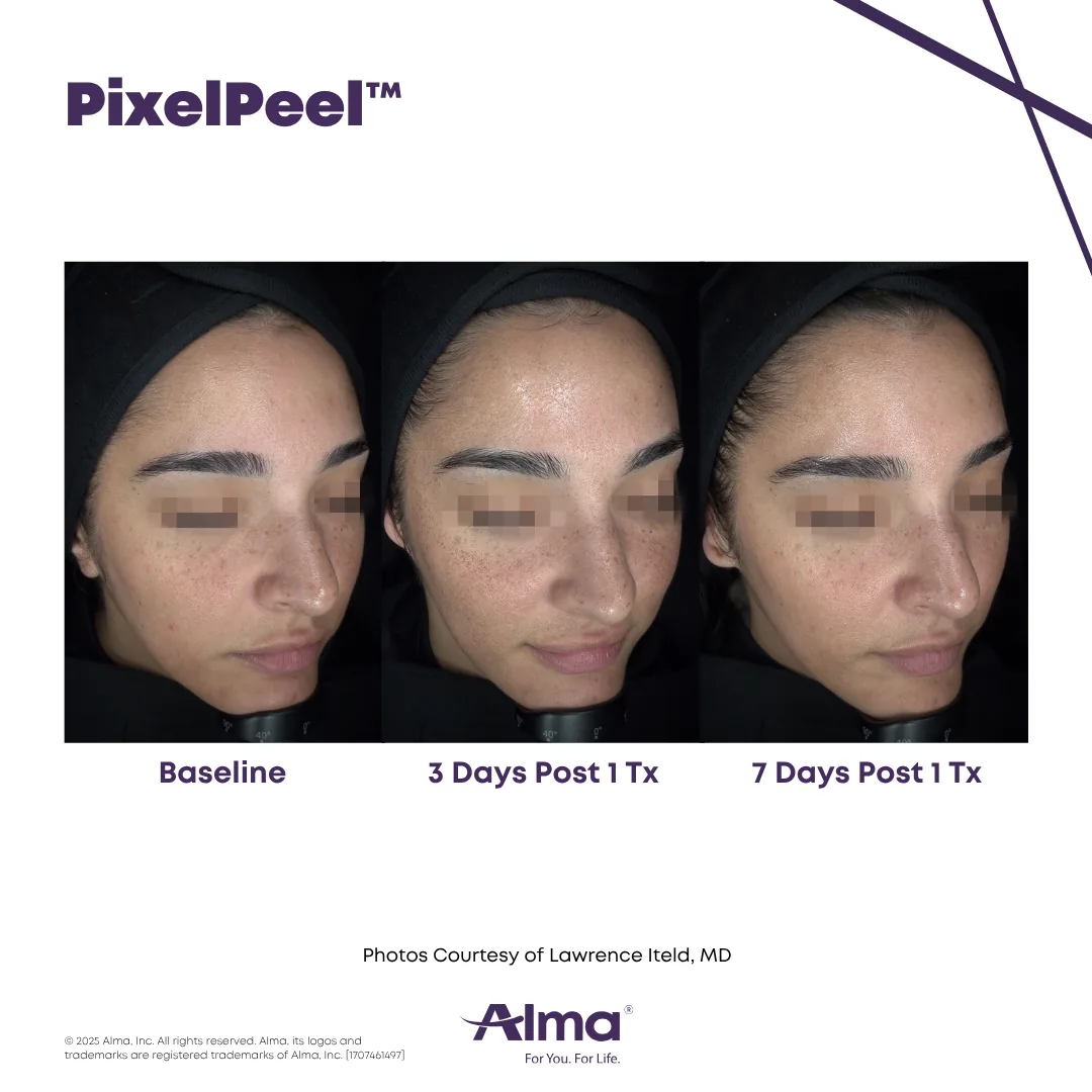 Before and after photo of fine lines improvement after PixelPeel CO2 laser skin resurfacing on the Alma Hybrid at Coastal Health & Medical Spa in Jacksonville