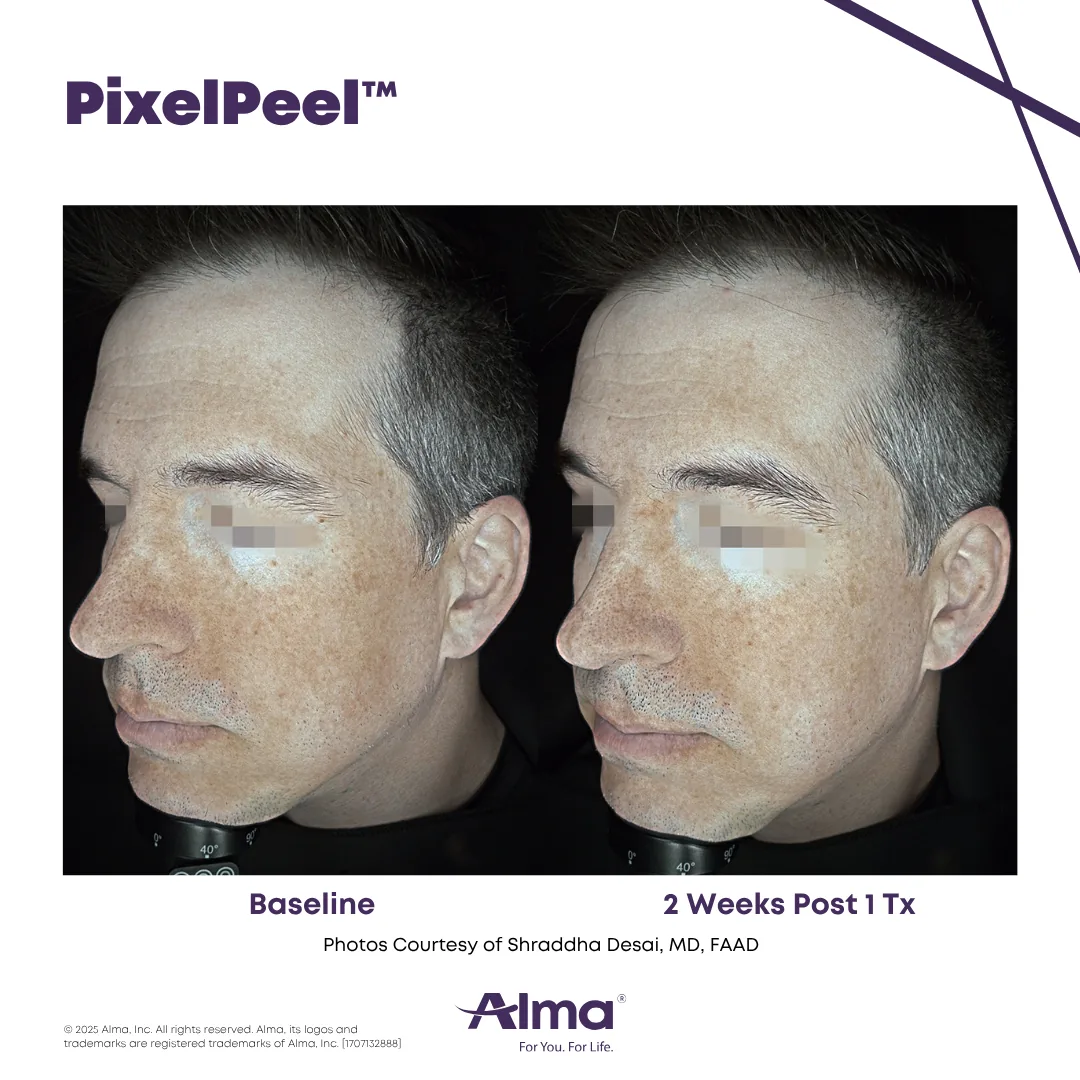 Before and after photo of pigmentation and sun-damage improvement after PixelPeel CO2 laser skin resurfacing on the Alma Hybrid