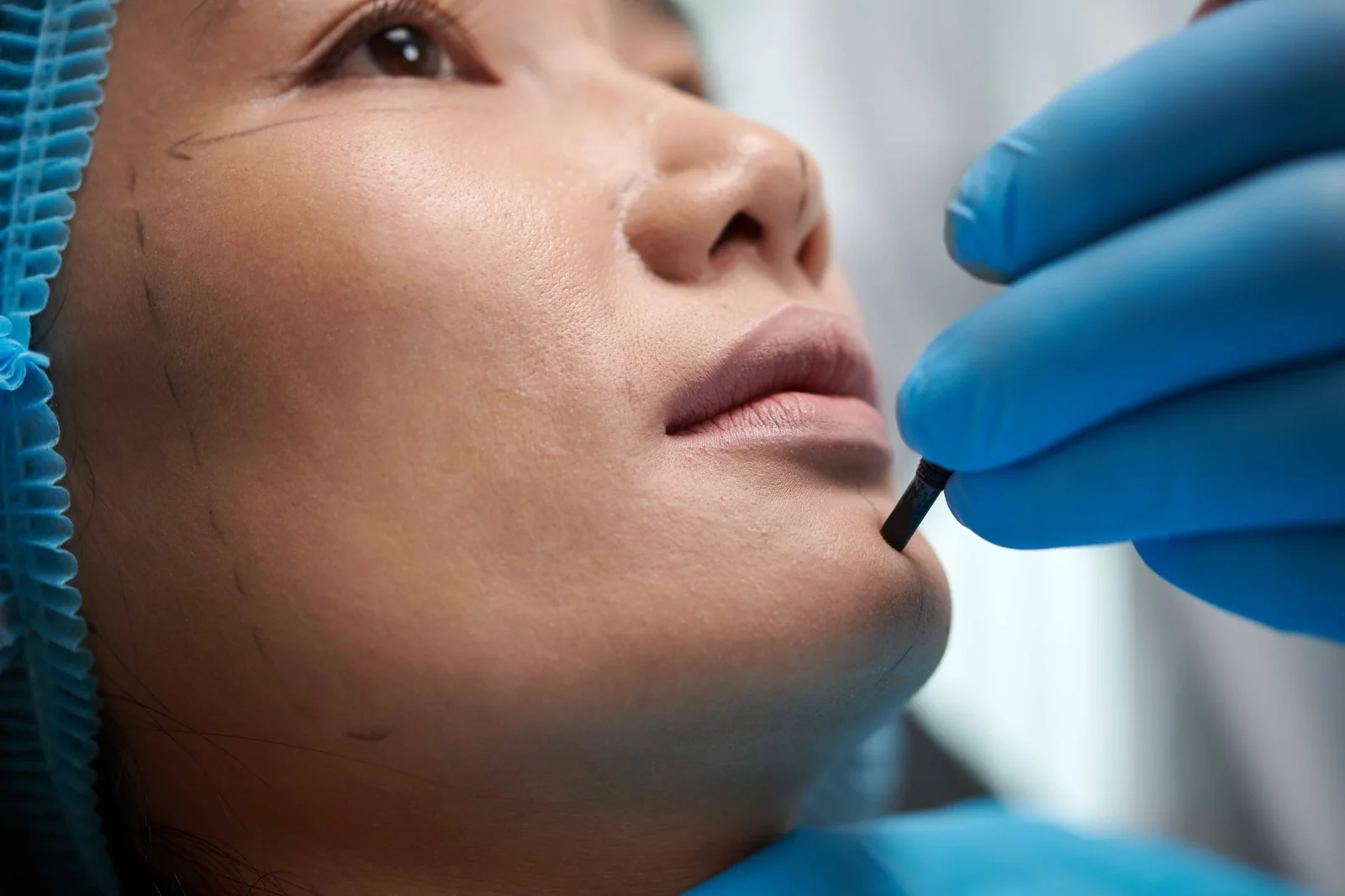 A close-up of a Sculptra jawline injection in Jacksonville, FL to sharpen and restructure the lower face at Coastal Health & Medical Spa