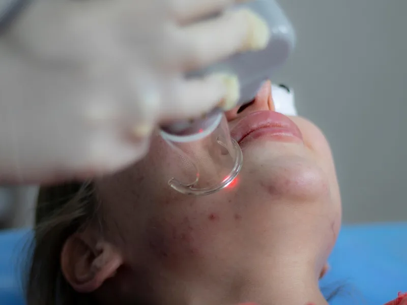 Targeted light therapy during an acne facial at a Jacksonville med spa