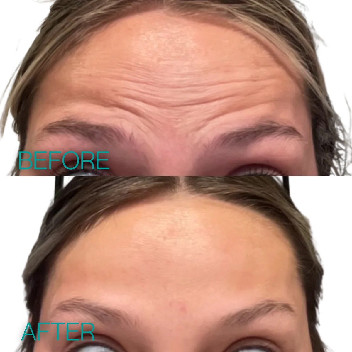 Wrinkle relaxer (Botox) before and after photo of a Coastal Health & Medical Spa in Jacksonville, FL patient showing smoothed horizontal forehead lines