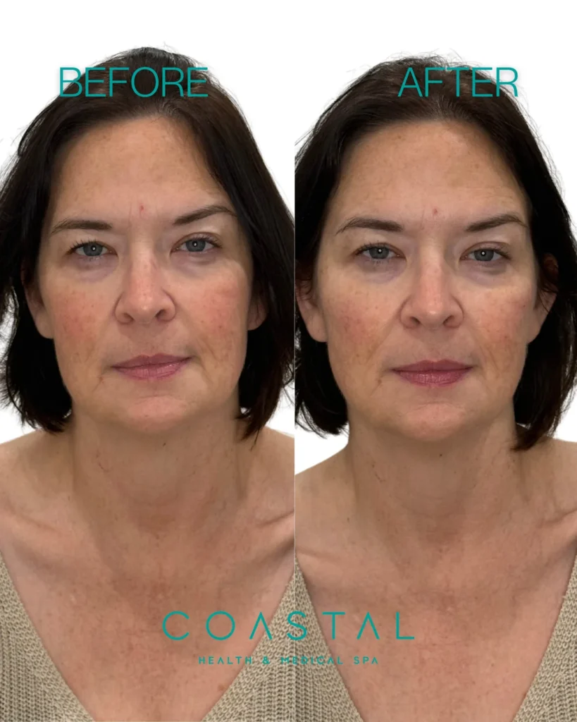 Cheek filler before and after photo of a Coastal Health & Medical Spa in Jacksonville, FL patient, front view showing restored midface volume and lifted cheeks