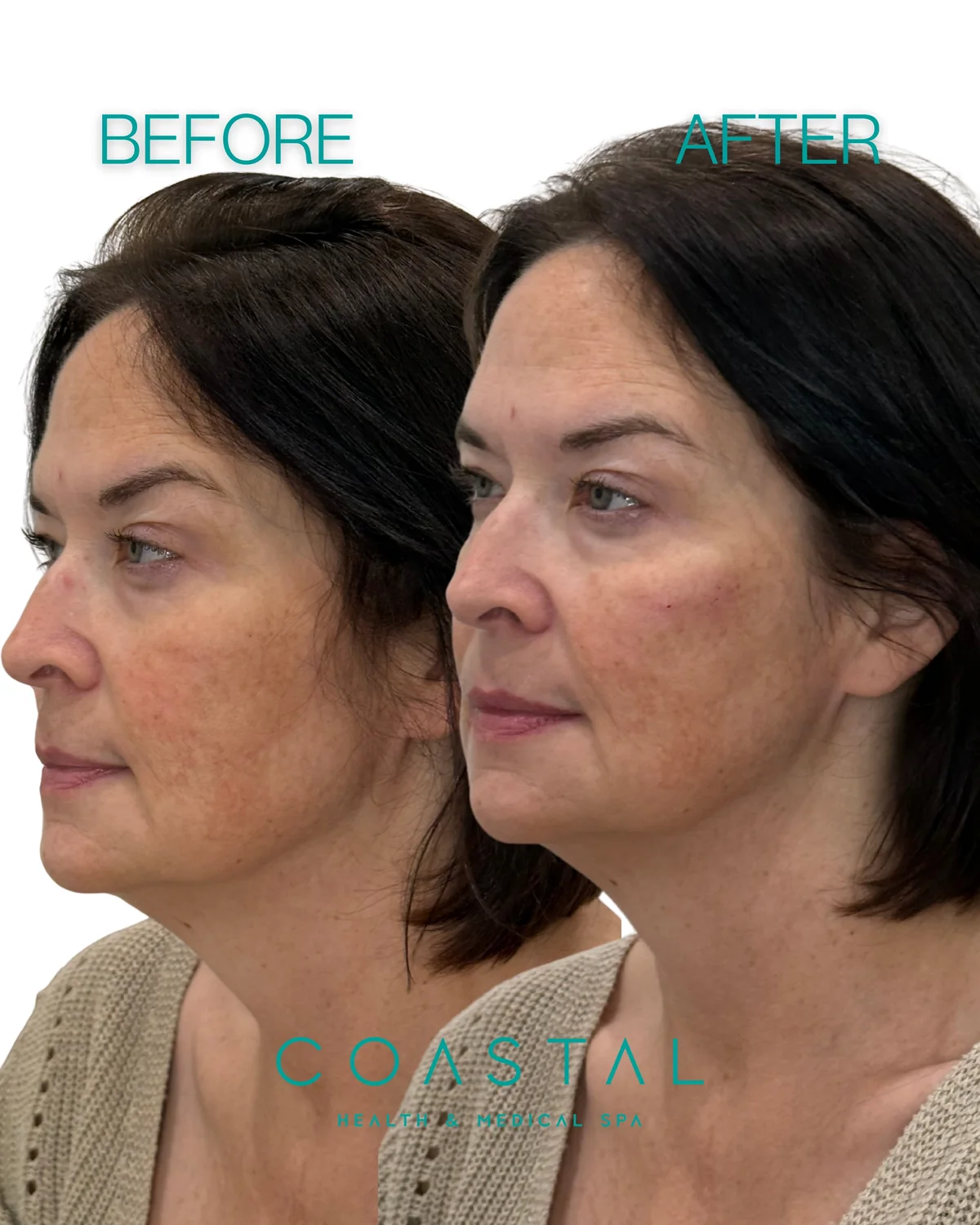 Cheek filler before and after photo of a Coastal Health & Medical Spa in Jacksonville, FL patient, three-quarter view showing lifted cheekbones and softer smile lines
