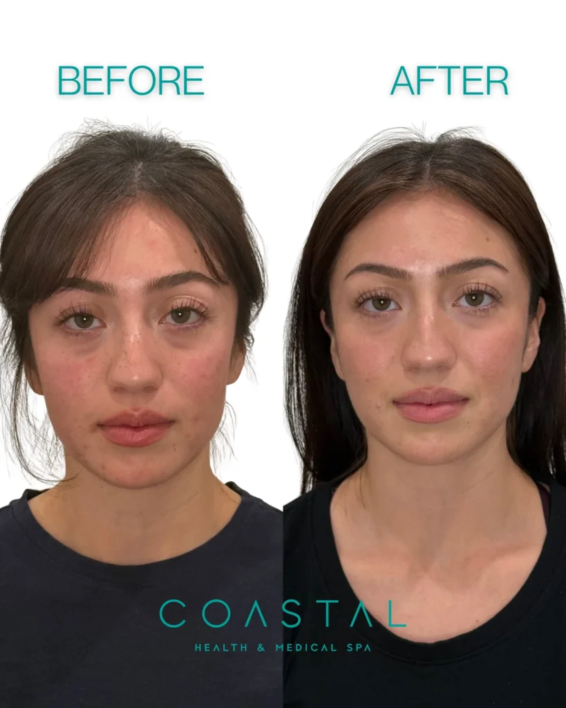 Cheek filler before and after photo of a Coastal Health & Medical Spa in Jacksonville, FL patient, front view showing fuller, more contoured cheeks