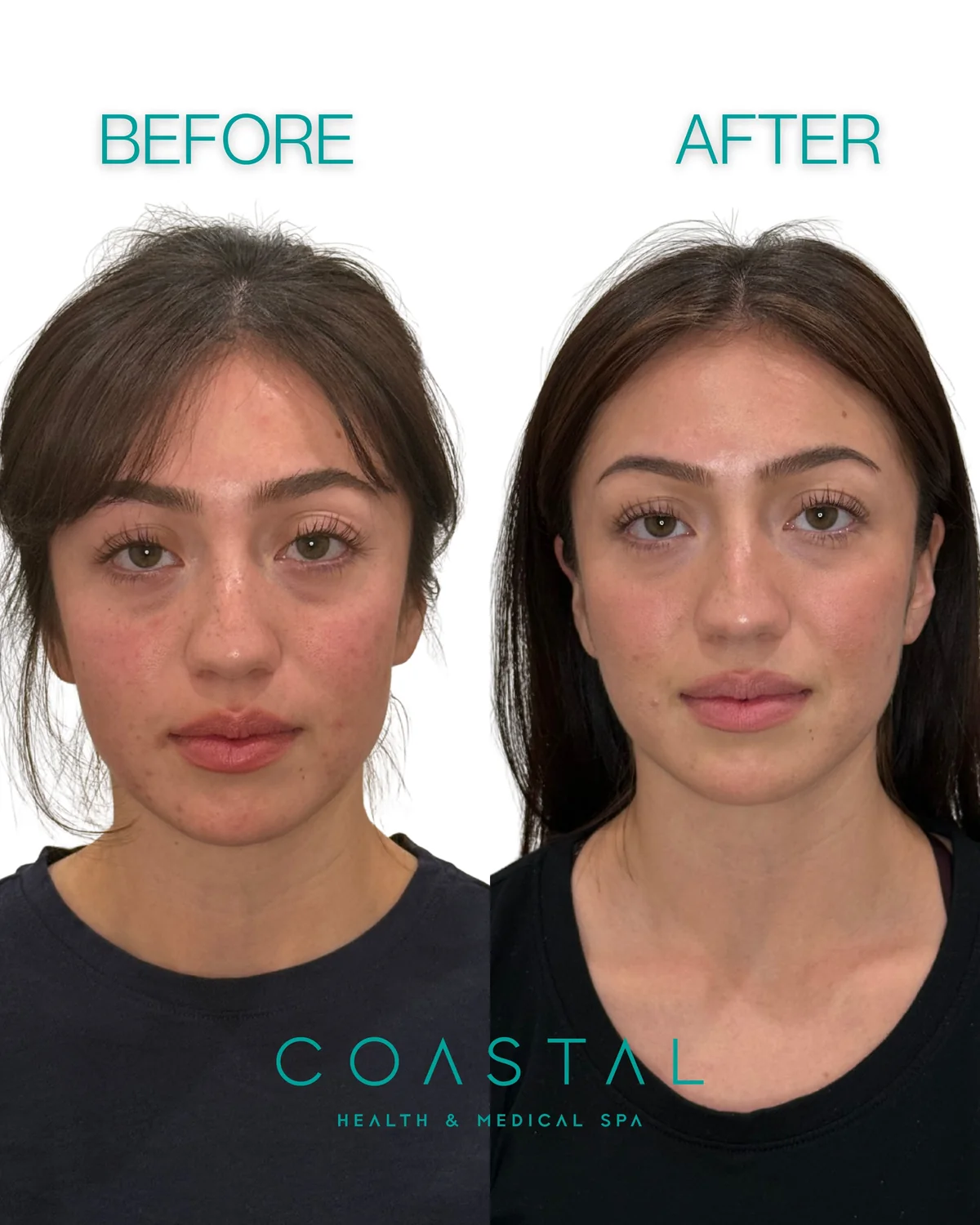Cheek filler before and after photo of a Coastal Health & Medical Spa in Jacksonville, FL patient, front view showing fuller, more contoured cheeks