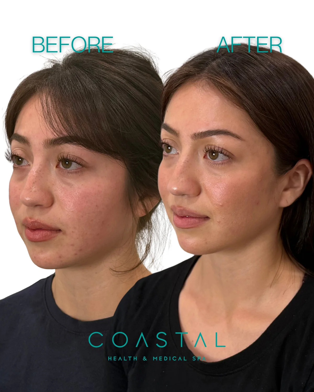 Cheek filler before and after photo of a Coastal Health & Medical Spa in Jacksonville, FL patient, three-quarter view showing a lifted midface