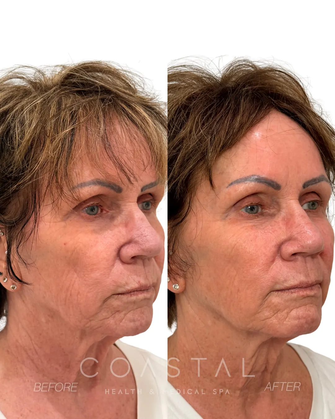 Facial balancing before and after photo of a Coastal Health & Medical Spa in Jacksonville, FL patient, three-quarter view showing a lifted midface, softer nasolabial folds and marionette lines, and a more defined jawline