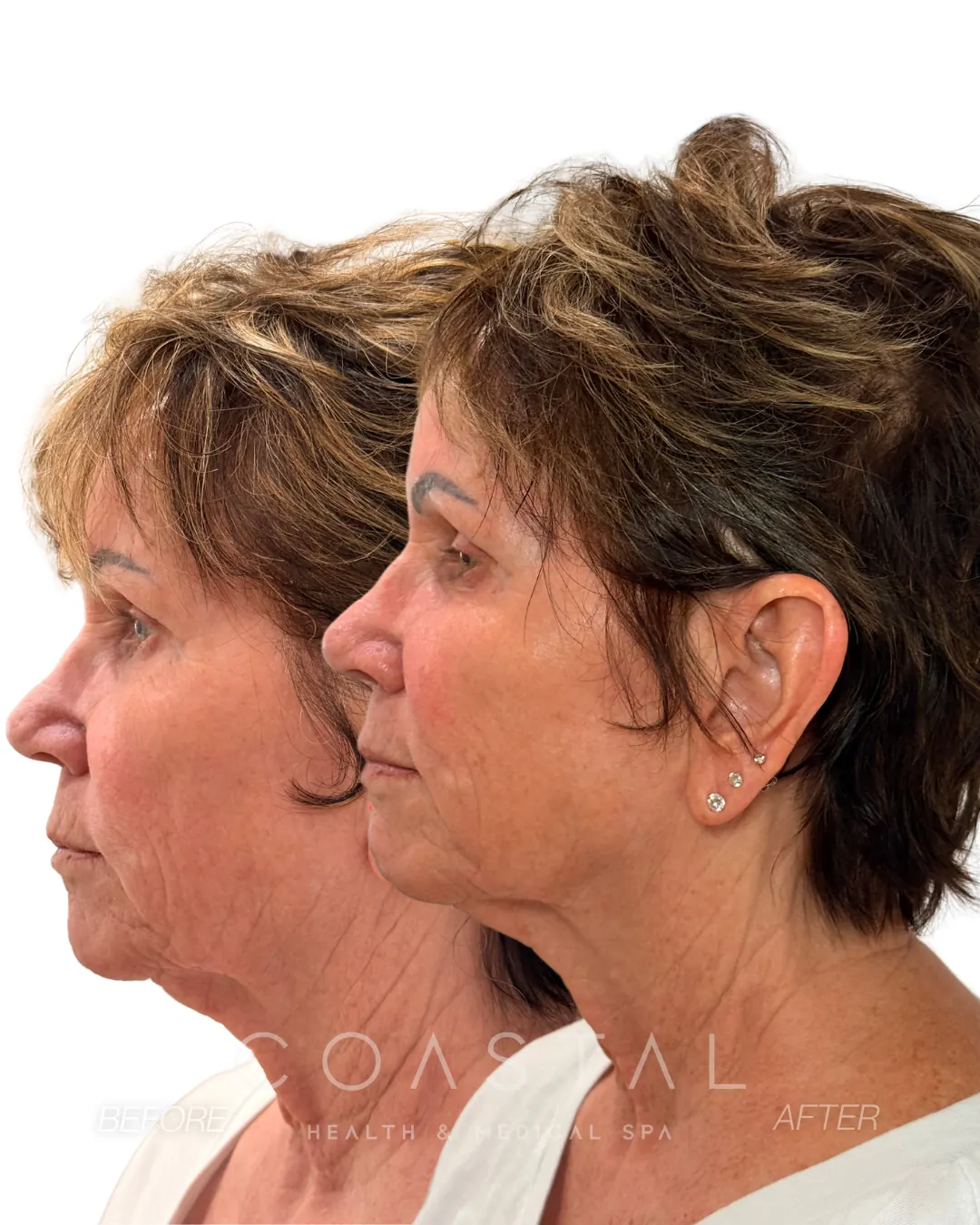 Facial balancing before and after photo of a Coastal Health & Medical Spa in Jacksonville, FL patient in profile showing restored cheek support and a smoother jawline and neck