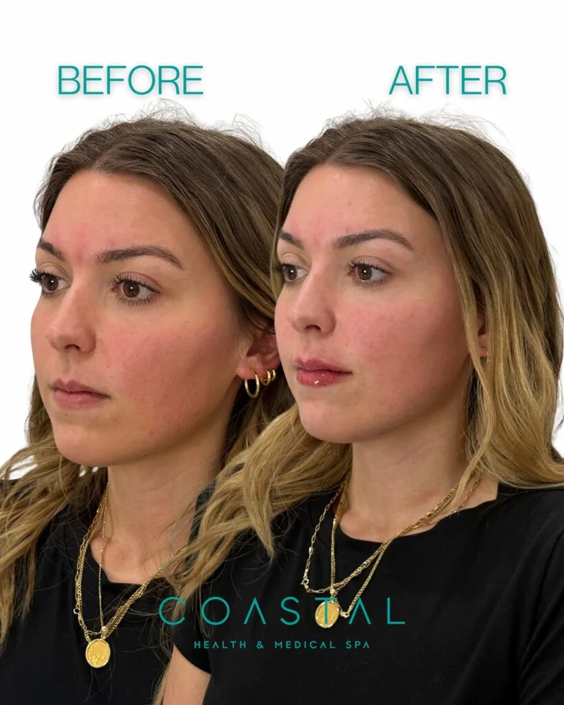 Angled lip filler before and after comparison of a Coastal Health & Medical Spa patient in Jacksonville, FL
