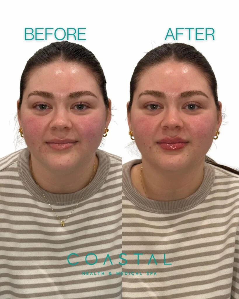 Lip filler before and after comparison of a Coastal Health & Medical Spa patient in Jacksonville, FL, side profile