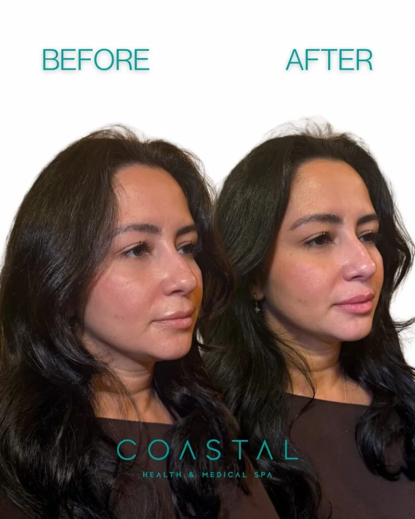 Close-up before and after of natural-looking lip filler done at Coastal Health & Medical Spa in Jacksonville, FL