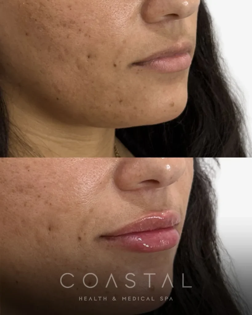 Lip filler before and after close-up of a Coastal Health & Medical Spa in Jacksonville, FL patient showing added volume and definition