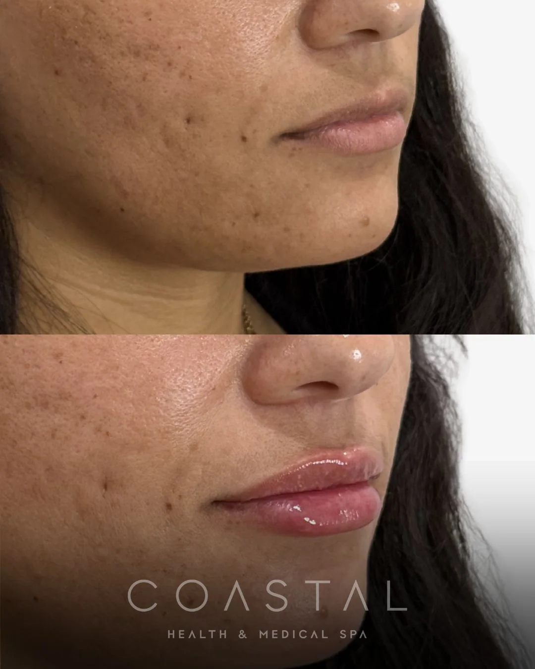 Lip filler before and after close-up of a Coastal Health & Medical Spa in Jacksonville, FL patient showing added volume and definition