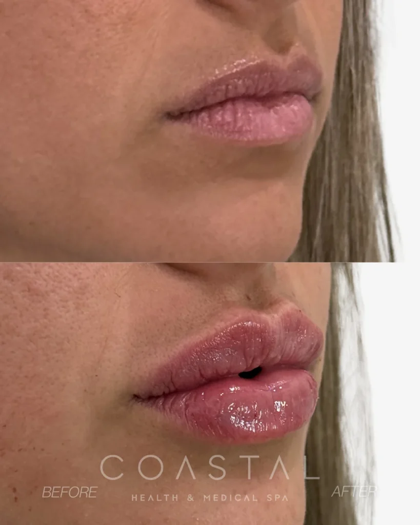 Close-up lip filler before and after photo of a Coastal Health & Medical Spa in Jacksonville, FL patient showing a fuller, hydrated upper and lower lip