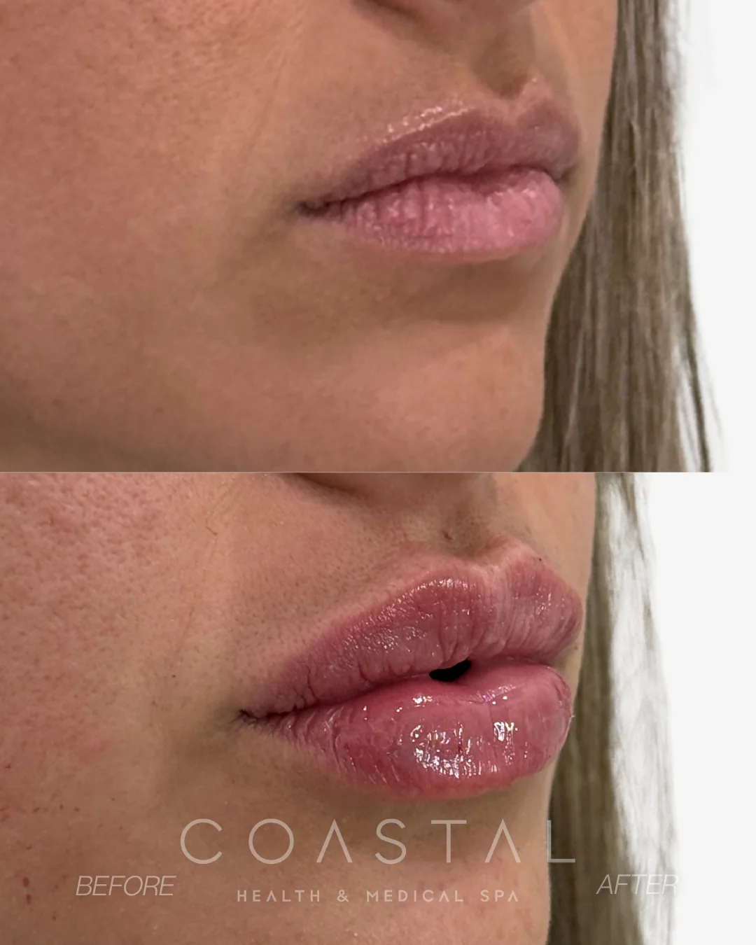 Close-up lip filler before and after photo of a Coastal Health & Medical Spa in Jacksonville, FL patient showing a fuller, hydrated upper and lower lip