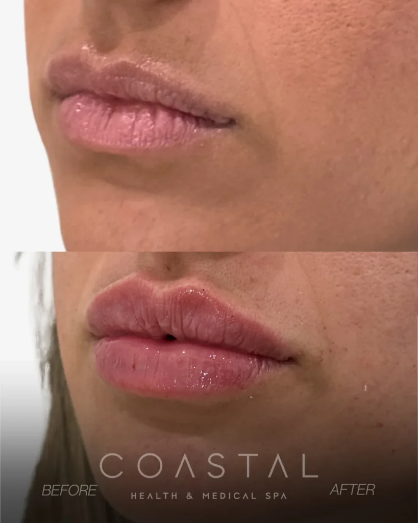 Close-up lip filler before and after photo of a Coastal Health & Medical Spa in Jacksonville, FL patient showing subtle added volume with a defined lip border