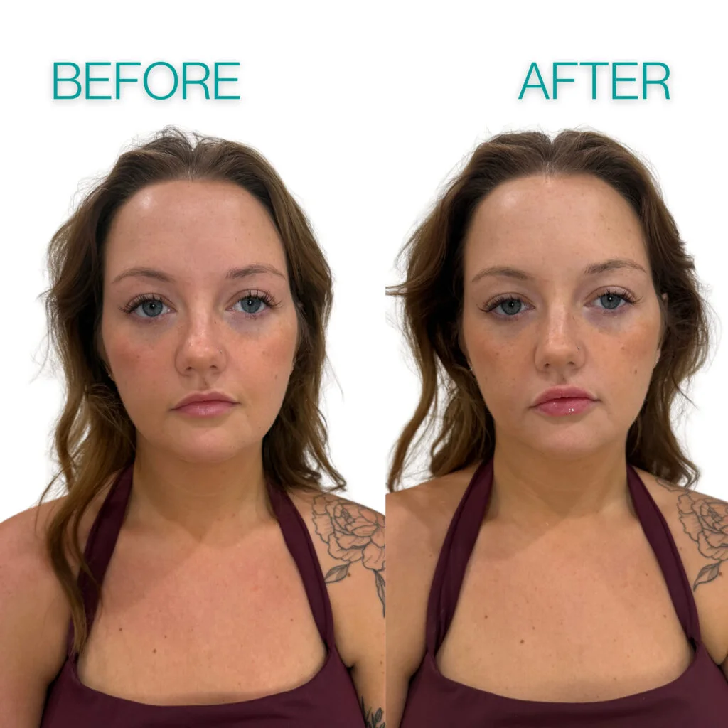 Lip filler before and after comparison of a young brunette Coastal Health & Medical Spa patient in Jacksonville, FL
