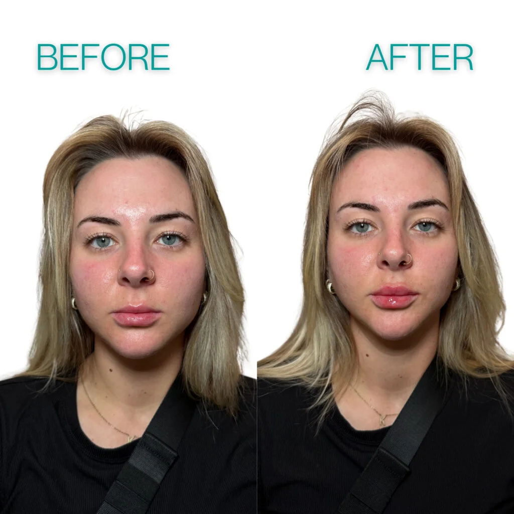 Lip filler before and after comparison of a young Coastal Health & Medical Spa patient in Jacksonville, FL