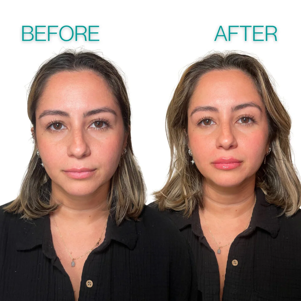 Lip filler before and after comparison of a Coastal Health & Medical Spa patient in Jacksonville, FL