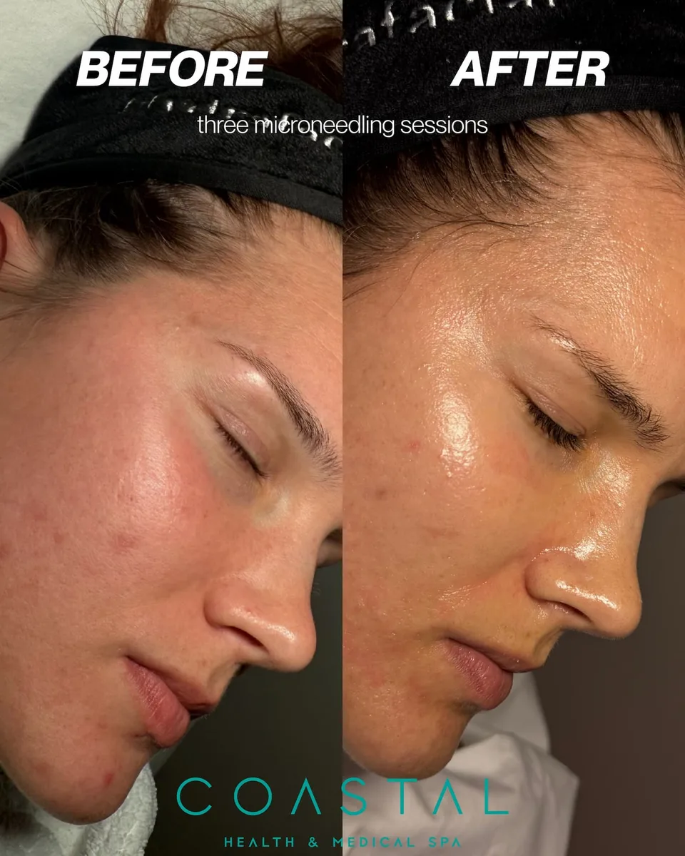 Before and after photo of a Coastal Health & Medical Spa patient in Jacksonville, FL, after three SkinPen microneedling sessions for acne texture and scarring.