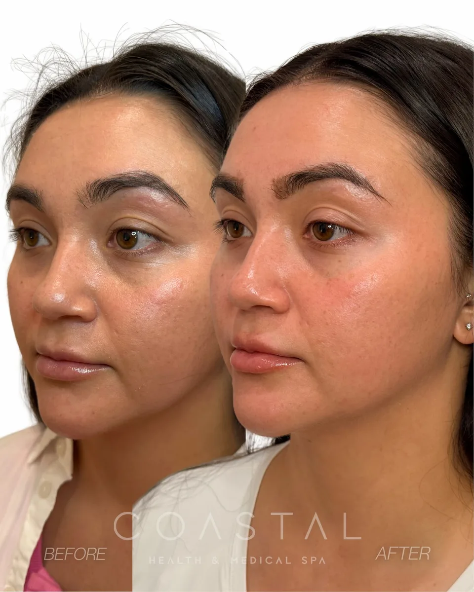 Microneedling before and after results on a real Coastal Health & Medical Spa patient in Jacksonville, FL, showing smoother texture and more even tone after a SkinPen series.