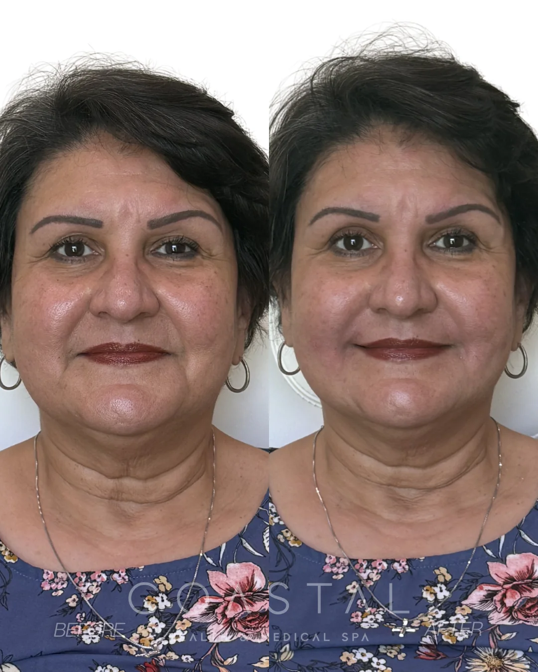 Before and after photo of a Coastal Health & Medical Spa patient in Jacksonville, FL showing softened nasolabial folds (smile lines) after dermal filler