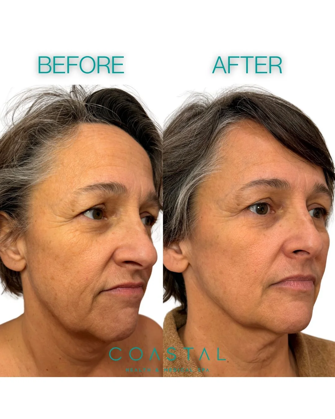 Before and after photo of a Coastal Health & Medical Spa patient in Jacksonville, FL showing softer smile lines and a smoother lower face