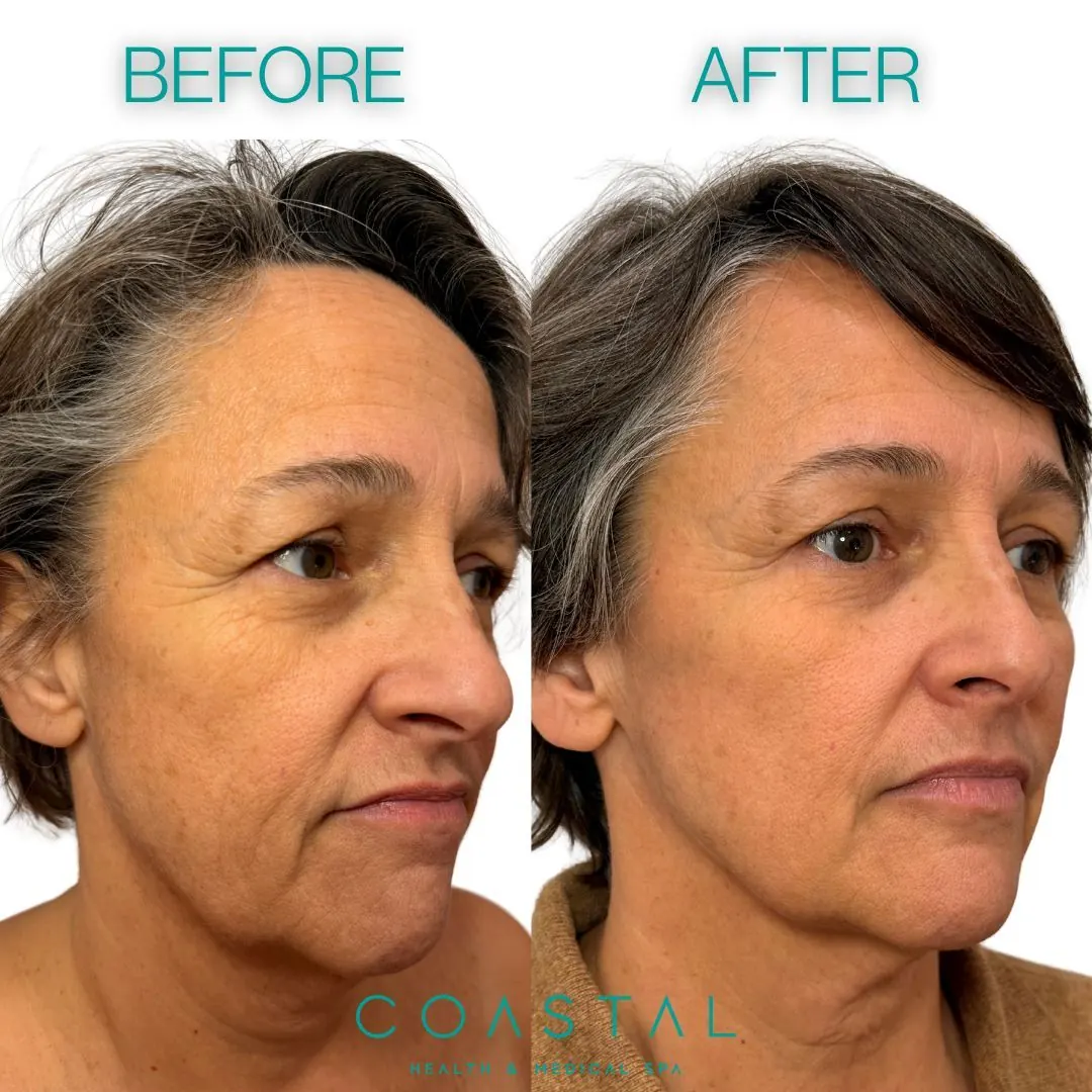 Smile line filler before and after photo of a Coastal Health & Medical Spa patient in Jacksonville, FL