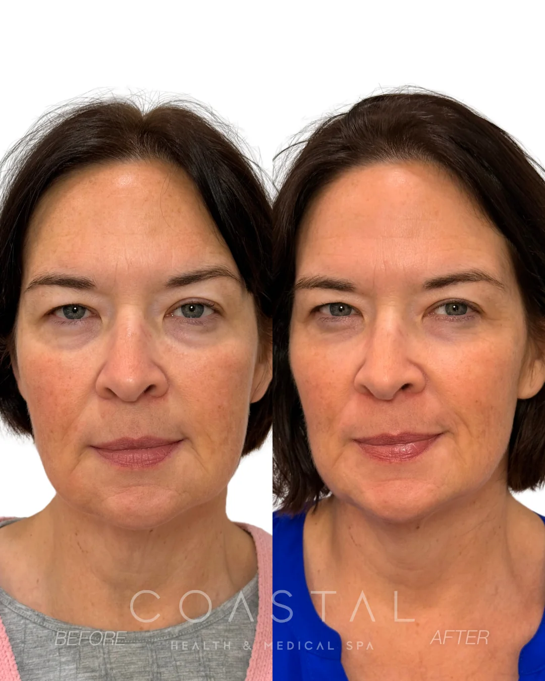 Before and after photo of a Coastal Health & Medical Spa patient in Jacksonville, FL showing a refreshed midface and softer nasolabial folds
