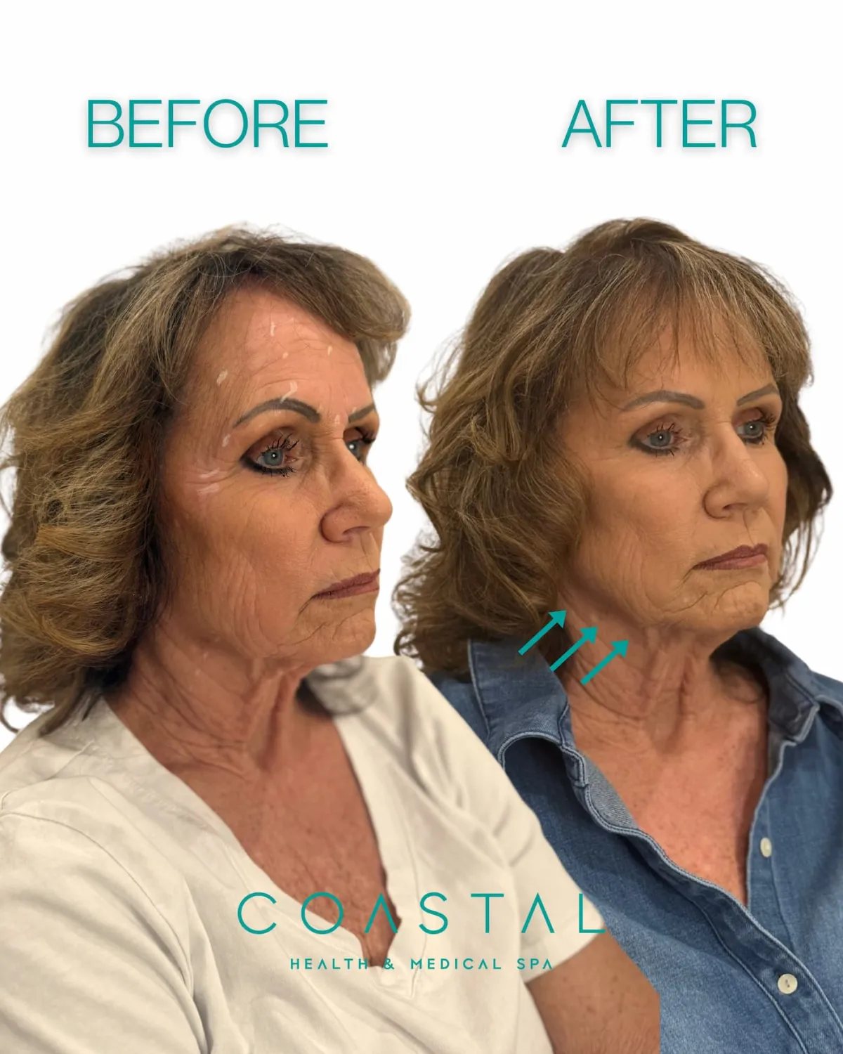 Before and after a Nefertiti neck lift at Coastal Health & Medical Spa in Jacksonville, showing a sharper jawline and softer neck bands