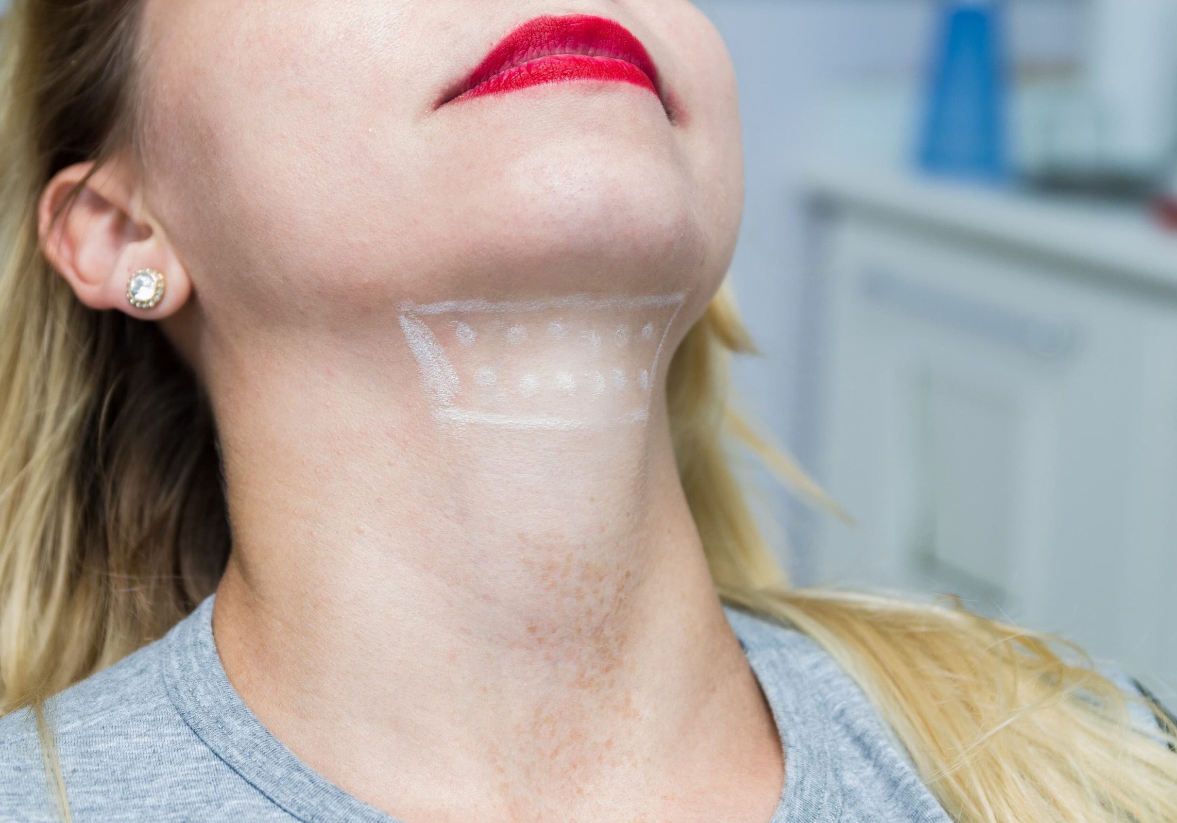 A woman in Jacksonville about to get a med spa treatment with with pre-injecton markings drawn on her chin