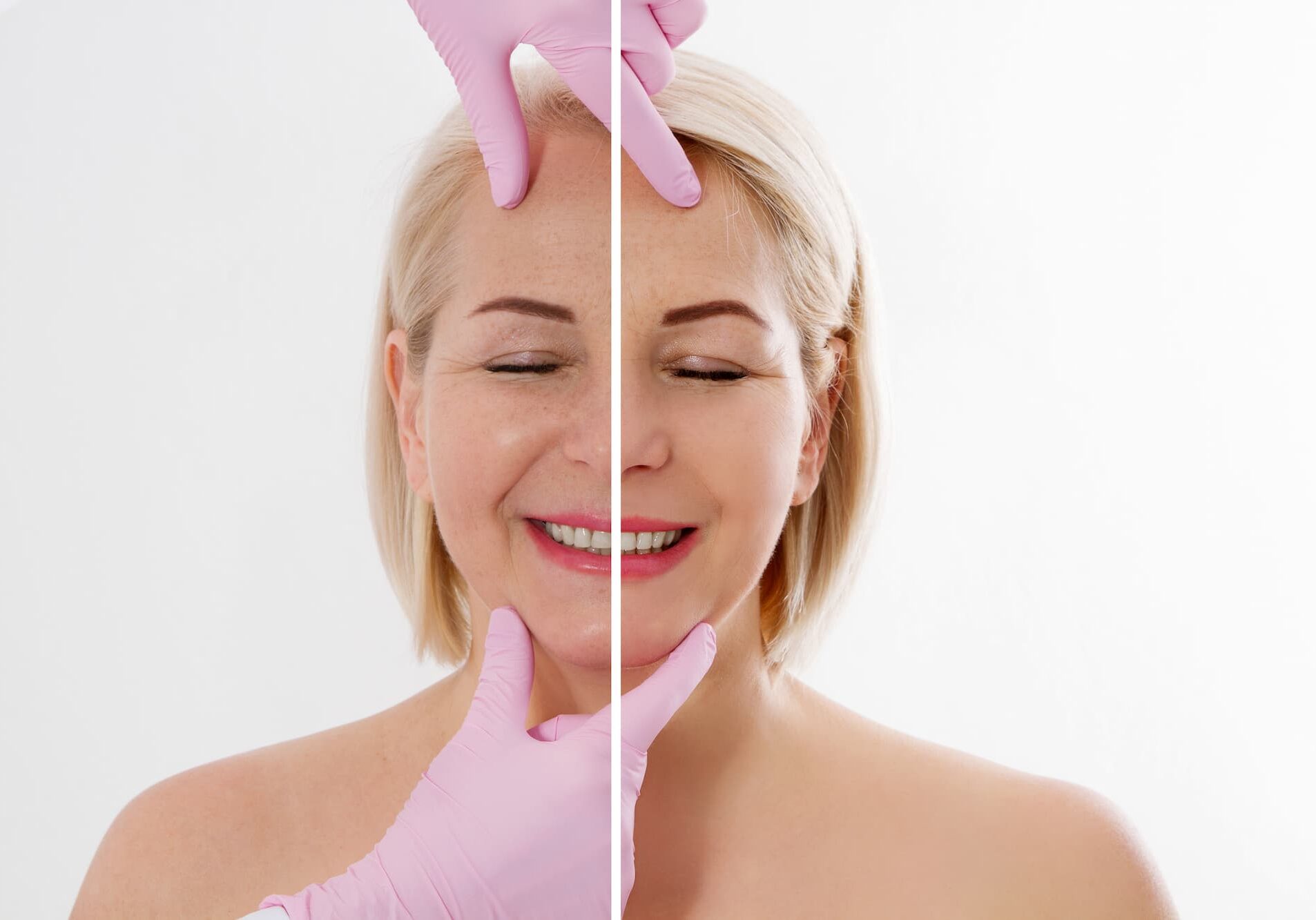 Woman getting Restylane Lyft in Jacksonville