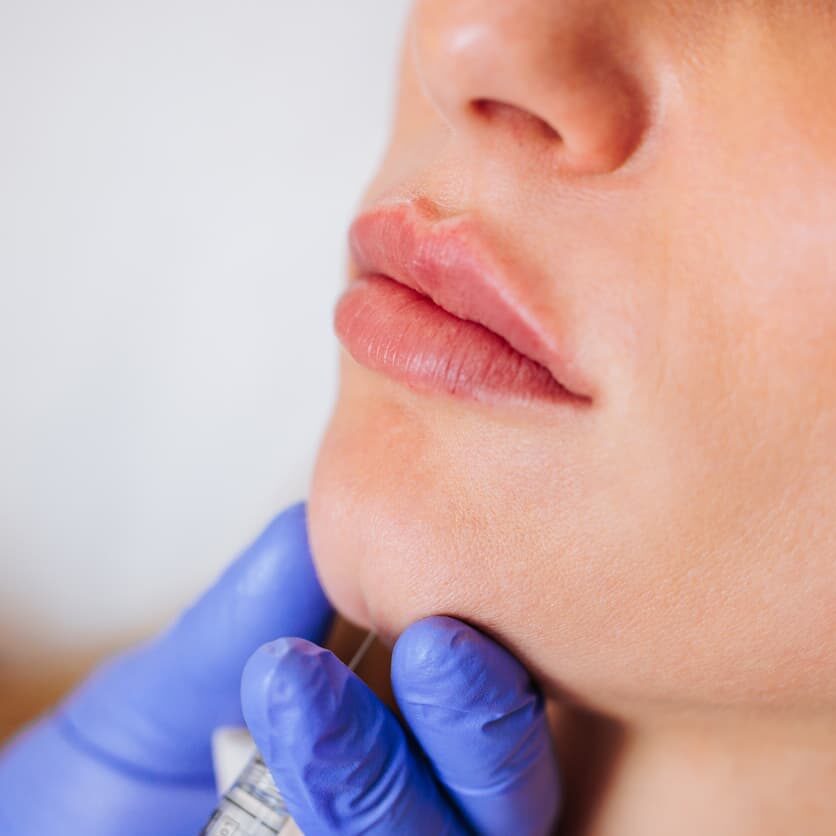 chin dermal filler